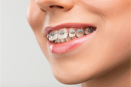 Odontolink - 30% de descuento en ortdoncia